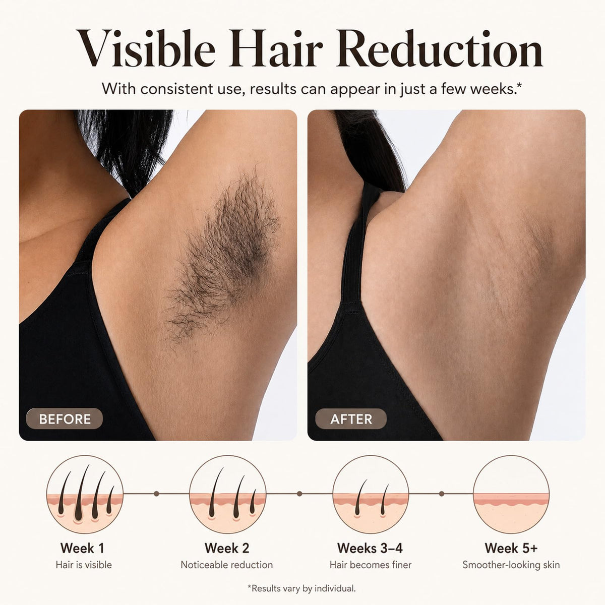 Laser Hair Removal Device B351
